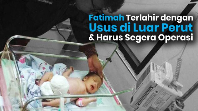 Bantu Fathimah, Bayi Penderita Omphalocele Sembuh