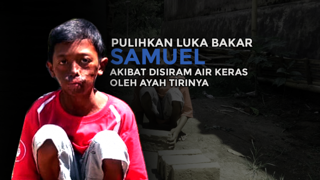 Bantu Pulihkan Luka Bakar Samuel