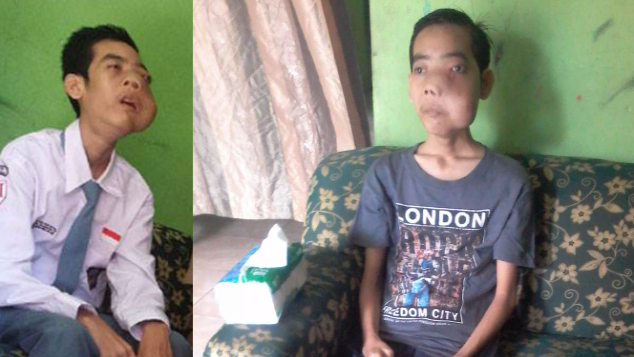 Bantu Ranggo Melawan Angiofibroma (Tumor Hidung)