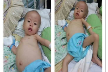 Indonesia Untuk Adam Penderita Atresia Bilier