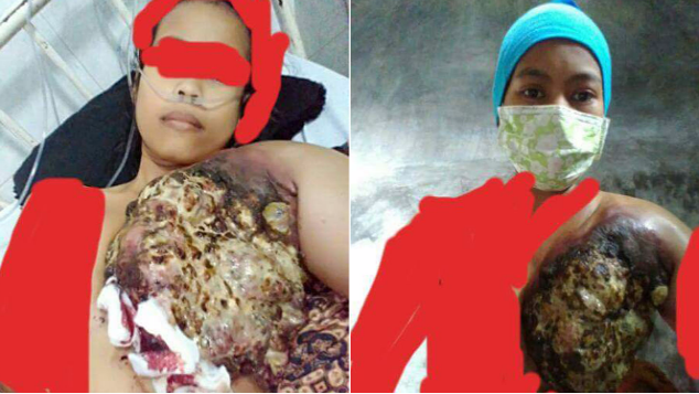 Bantu Hilangkan Kanker Payudara Bu Yanti