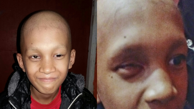 Uluran Tangan Untuk Anak Kang Apes (Tumor di Mata)