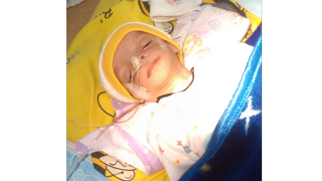 Alfi dan Treacher Collin Syndrome (TCS)