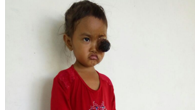 PEDULI ADEK BELLA (3 TAHUN) PENDERITA TUMOR MATA