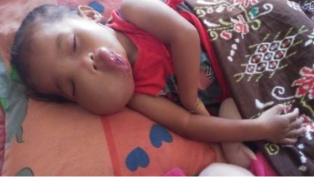 Rini Kecil Butuh Uluran Tangan Anda untuk Operasi