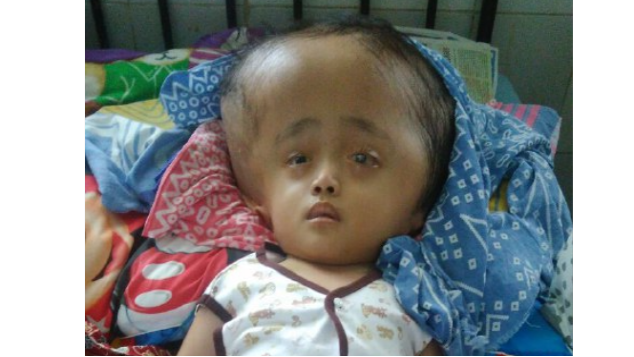 Bantu Hadi Sembuh dari Hydrocephalus