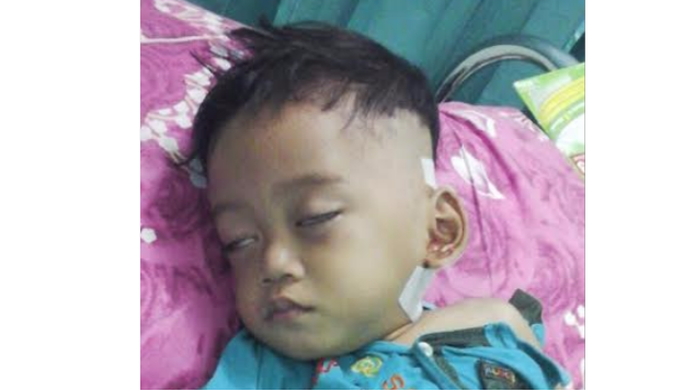 Abses ringan berujung pada Tumor di Kepala
