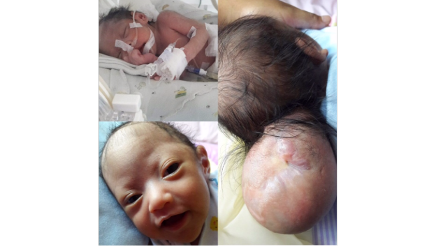 Baby Sophia, Meningoencephalocele Fighter