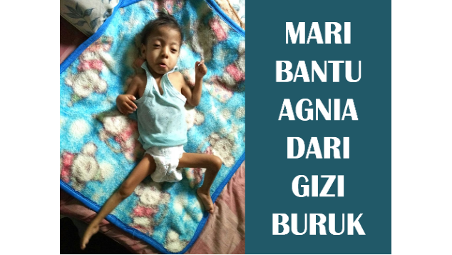Bantu Agnia dari Gizi Buruk