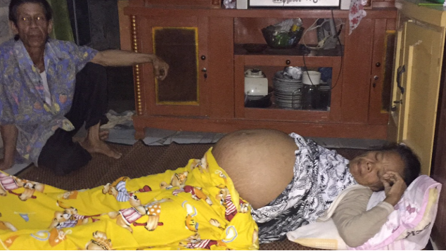 Bantu Bu Odah Melawan Tumor Ganas