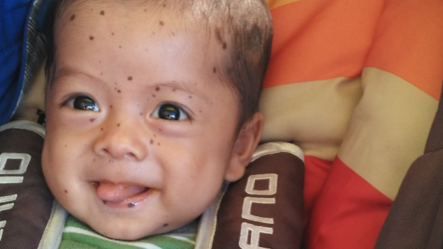 #BantuGhaidan #BabyNevus Terus Tersenyum