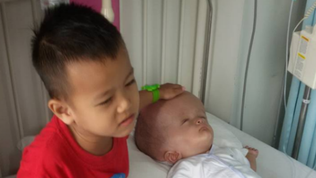 BIAYA OPERASI HIDROSEFALUS BUAT SI KECIL MARTIN