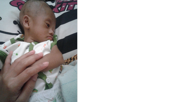 Operasi Jantung Bayi Alvin