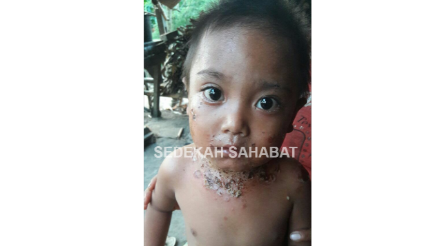 Bantu Khairul Sembuh dari Penyakit Kulit