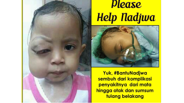 #BantuNadjwa Melawan Tumor Mata