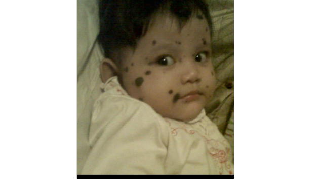 Yuk Bantu Syifa - Balita Nevus Owner (CMN)