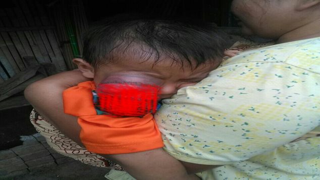 Operasi Untuk Raffa