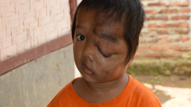 Bantu Subhan Kecil Sembuh dari Tumor