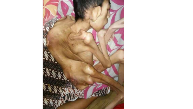 Bantu Yusuf Sembuh dari Penyakit Meningitis