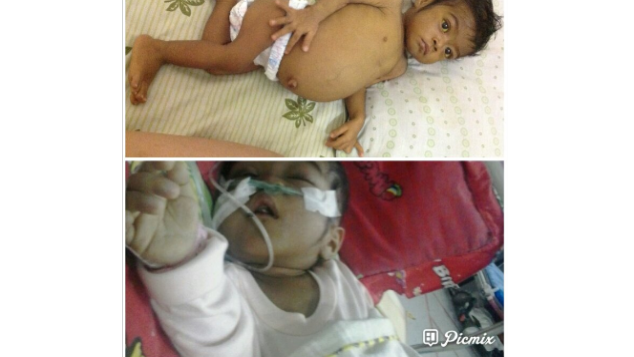 Bantu Naura (Atresia Billier dan Gizi buruk)
