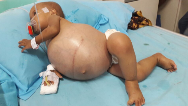 Bantu Bayi Sheyla Sembuh dari Tumor Ginjal