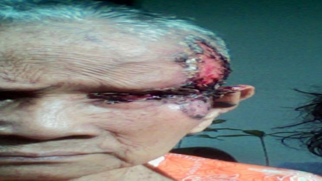 operasi kanker nenek cacah