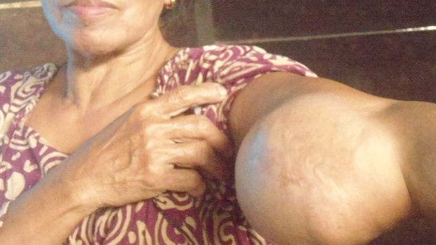 BANTU MELAWAN TUMOR