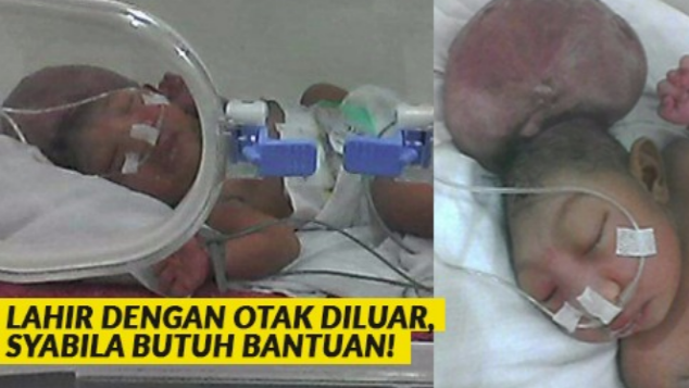 Otak Diluar Kepala, Syabila Harus Segera Dioperasi