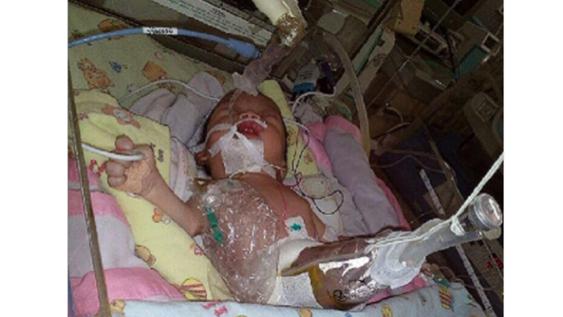 Bantu Azzahra ( gastroschisis, usus di luar perut)