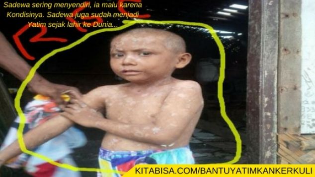 Bantu Anak Yatim Penderita Kanker Kulit