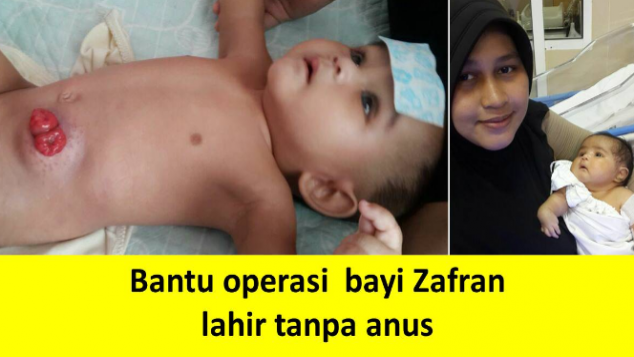 Bantu operasi bayi Zafran, lahir tanpa anus