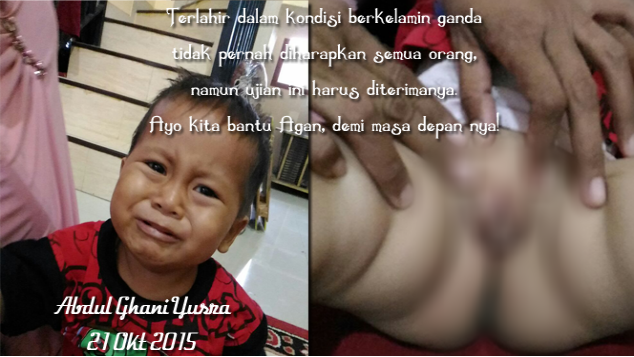 Berkelamin Ganda, Agan Butuh Di Operasi