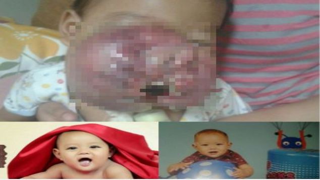 Peduli Khadafi | Tumor Jaringan Lunak