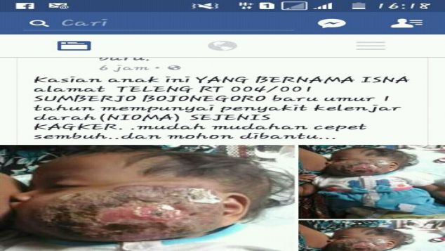 Donasi Bagi Isna, Balita Penderita Penyakit Langka