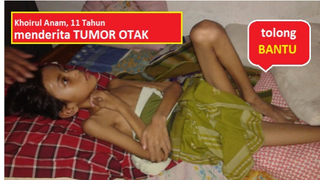 Bantu dik Khoirul yang menderita tumor otak 5 cm