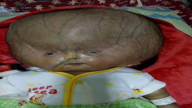 bantu fauzan melawan hidrosepalus