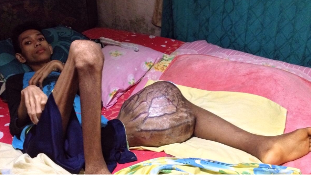 1 TAHUN LEBIH BERBARING DENGAN TUMOR GANAS BESAR