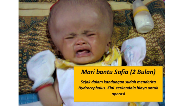 Bantu Sofia Sembuh dari Hydrocephalus