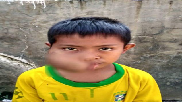 Bantu Pengobatan Torticollis “Rizki Mubarak”