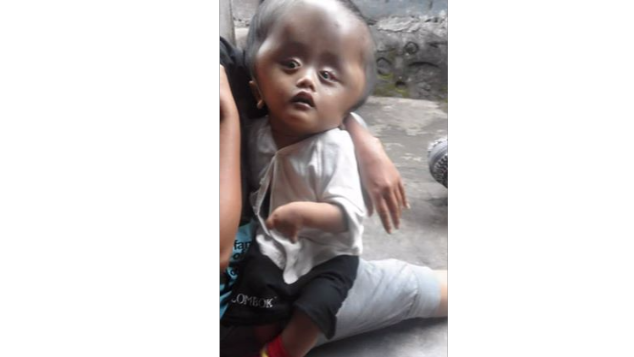 Bantu Aprilian Sembuh dari Penyakit Hidrocefalus