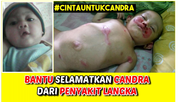 BANTU SELAMATKAN CANDRA DARI PENYAKIT LANGKA