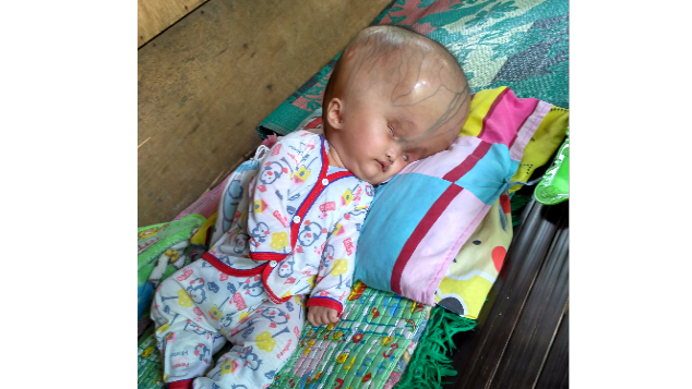 Sifa kembali ceria dan sembuh dari Hidrocefalus