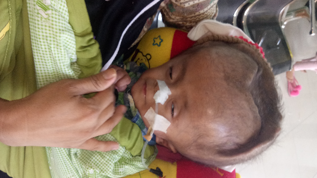 dede bayi usia 6 bulan penyakit hydrosephalus