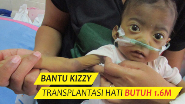 Bantu Kizzy, Transplantasi Hati Butuh 1,6M