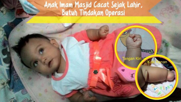 Hamidah mungil ini, di uji kelainan Sindaktili