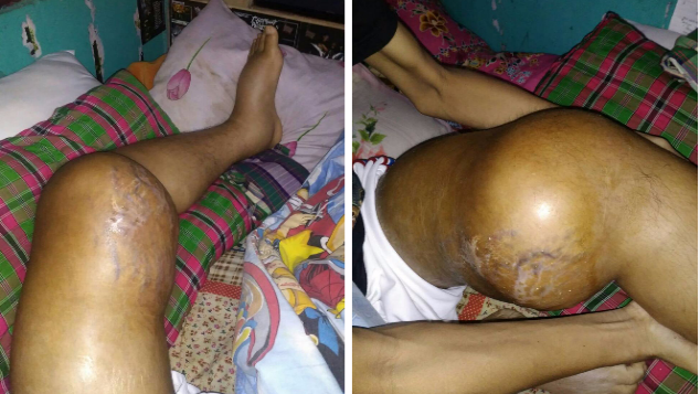Donasi Untuk Agus (Cancer Osteosarcoma)