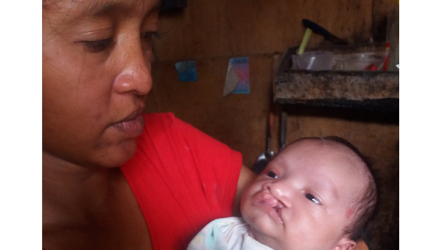 Bantu Ibu Diah Operasi Bibir Sumbing Anaknya