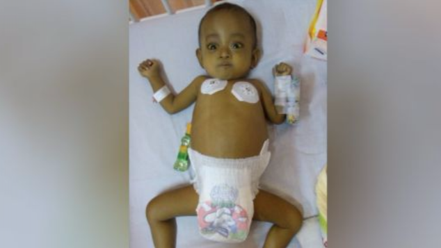 Cangkok Hati untuk Bayi Penderita Atresia Bilier