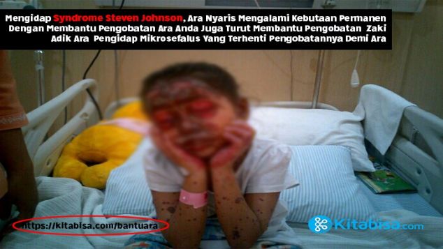 Bantu Ara sembuh dari Steven Johnson Syndrome