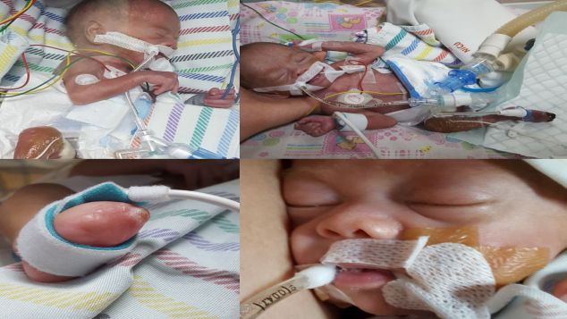 Yuk bantu biaya perawatan baby Clint (24weeker)